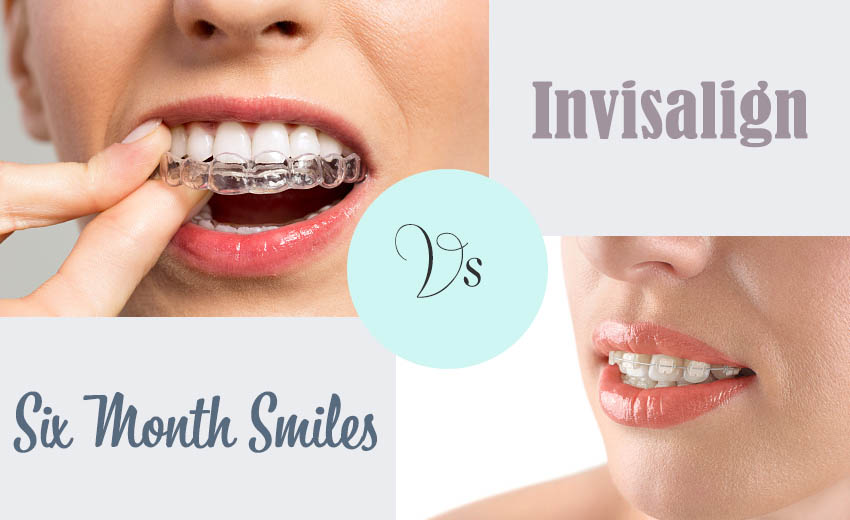 Six Month Smiles vs Invisalign