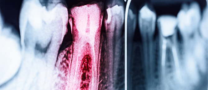 Tooth xray