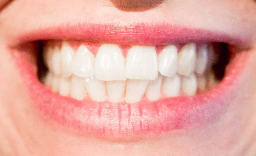 close up of womans smile showing upper and lower teeth