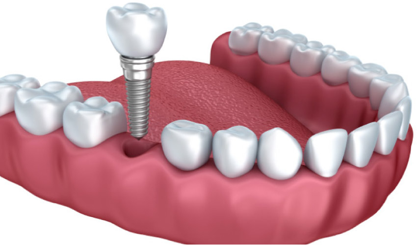 model demonstrating the dental implant procedure