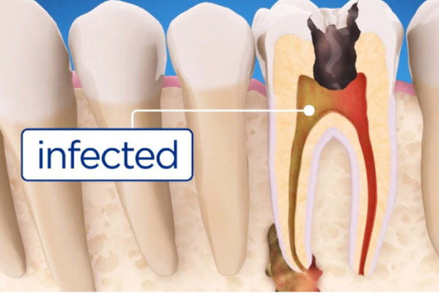 illustrated of an infected tooth needing root canal therapy