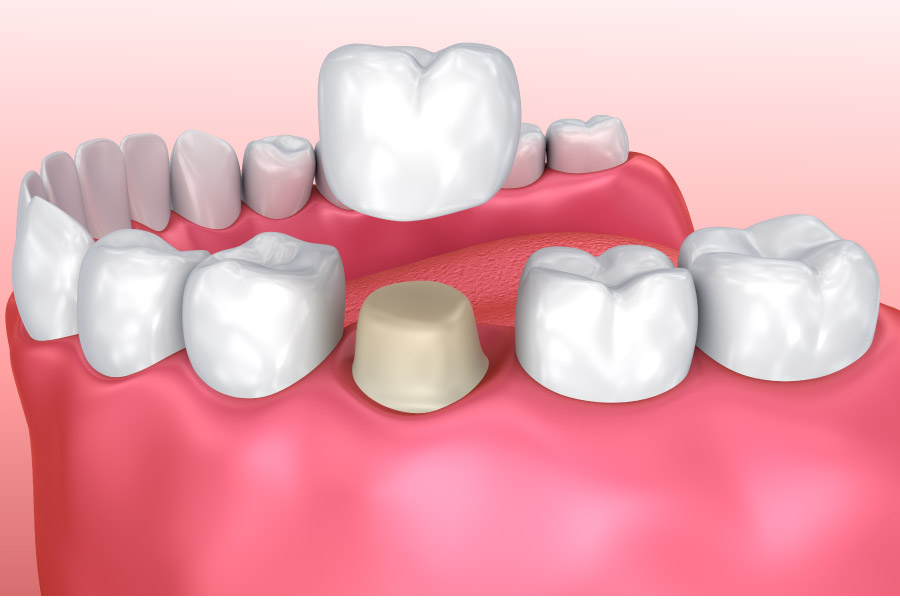 dental crown model