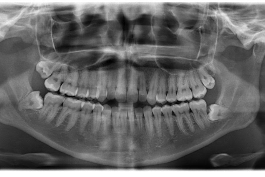 X-ray showing mouth panorama