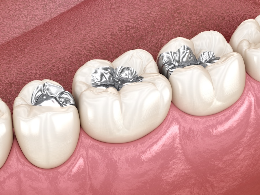 Graphic of silver fillings, amalgam fillings. Some patients may replace with tooth-colored fillings. Dentist in San marcos