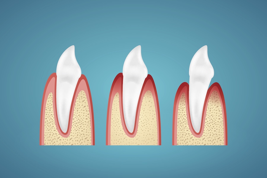 image of stages of periodontal disease